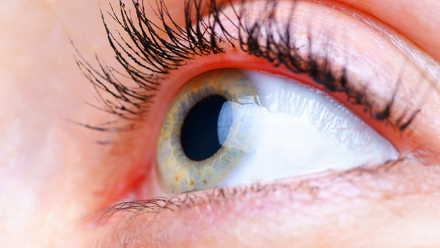 Corneal Erosion Causes & Treatment